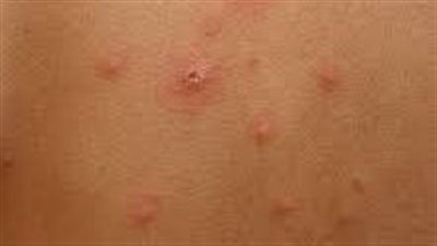 احذر | انتشار الجديري المائي بين طلاب المدارس ..وقرارات عاجلة من التعليم